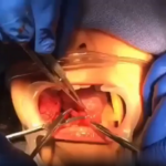 Cyst Removal